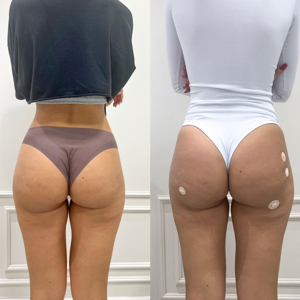 Remodelação Glútea