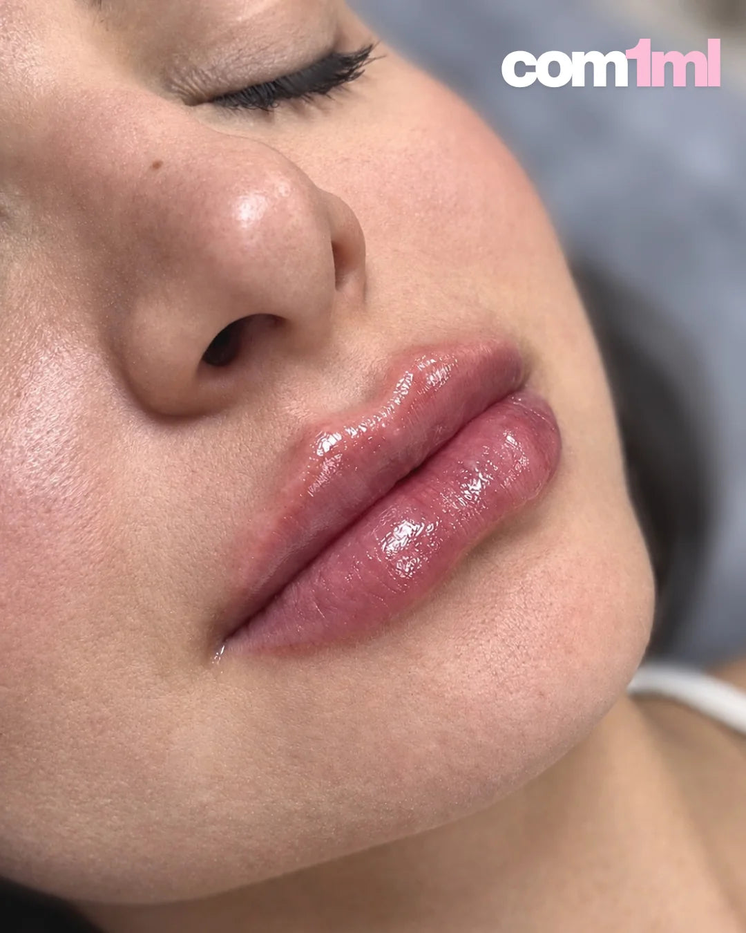 Preenchimento Labial Restylane Kysse com Anestesia