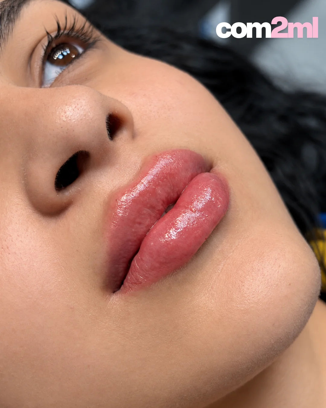 Preenchimento Labial Restylane Kysse com Anestesia
