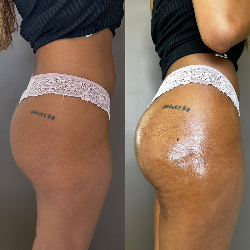 Remodelação Glútea