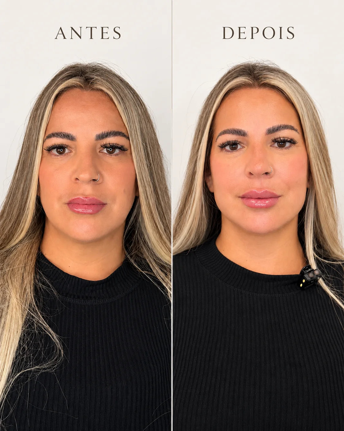 Harmonização Facial Rennova 10 ml com Anestesia