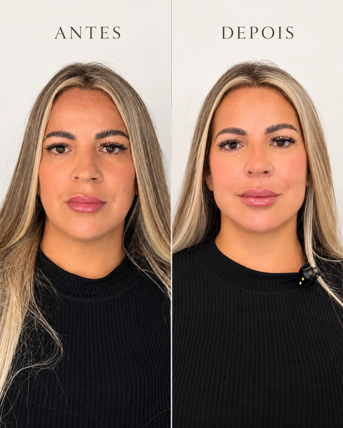 Harmonização Facial Rennova 10 ml com Anestesia