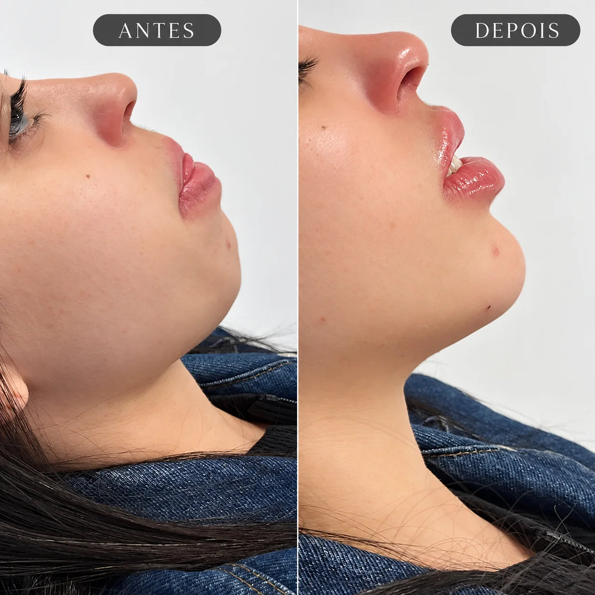Preenchimento de Mento Restylane Shaype com Anestesia