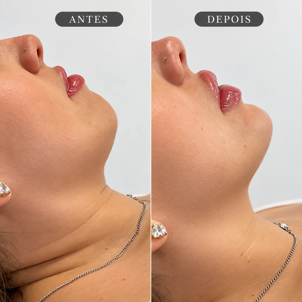 Preenchimento de Mento Restylane Shaype com Anestesia