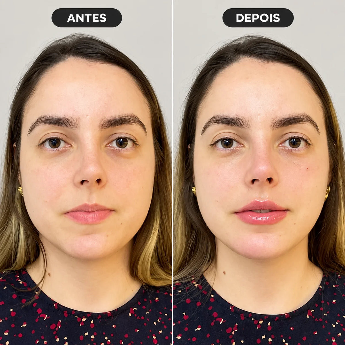 Preenchimento Bigode Chinês Restylane Refyne com Anestesia