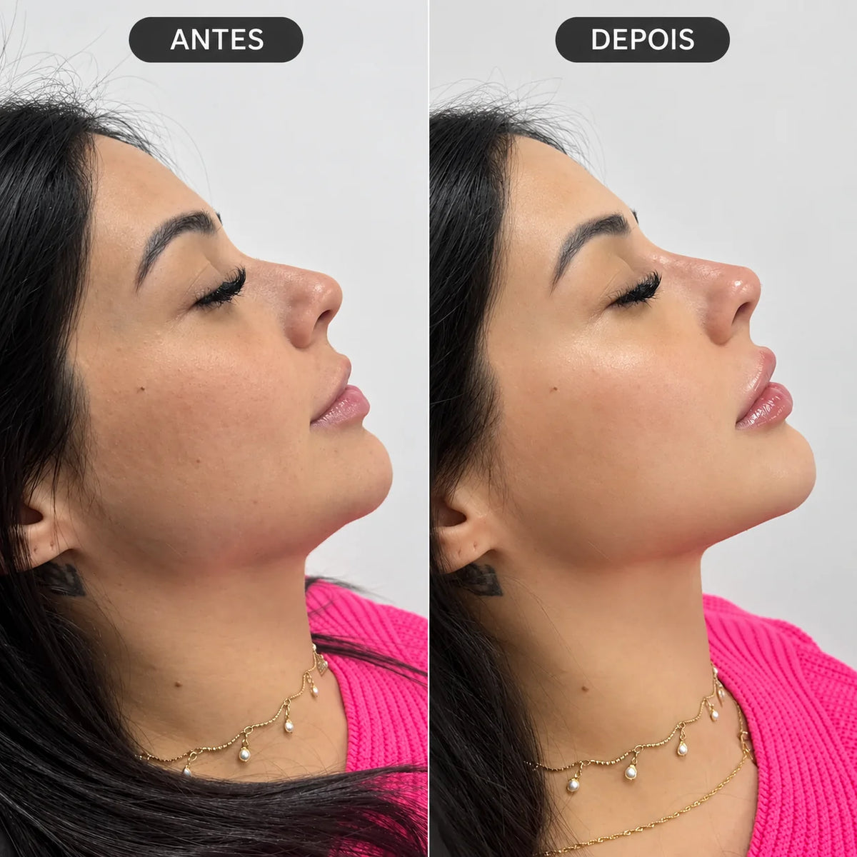Perfiloplastia MAP 3 com Ácido Hialurônico sem Cirurgia