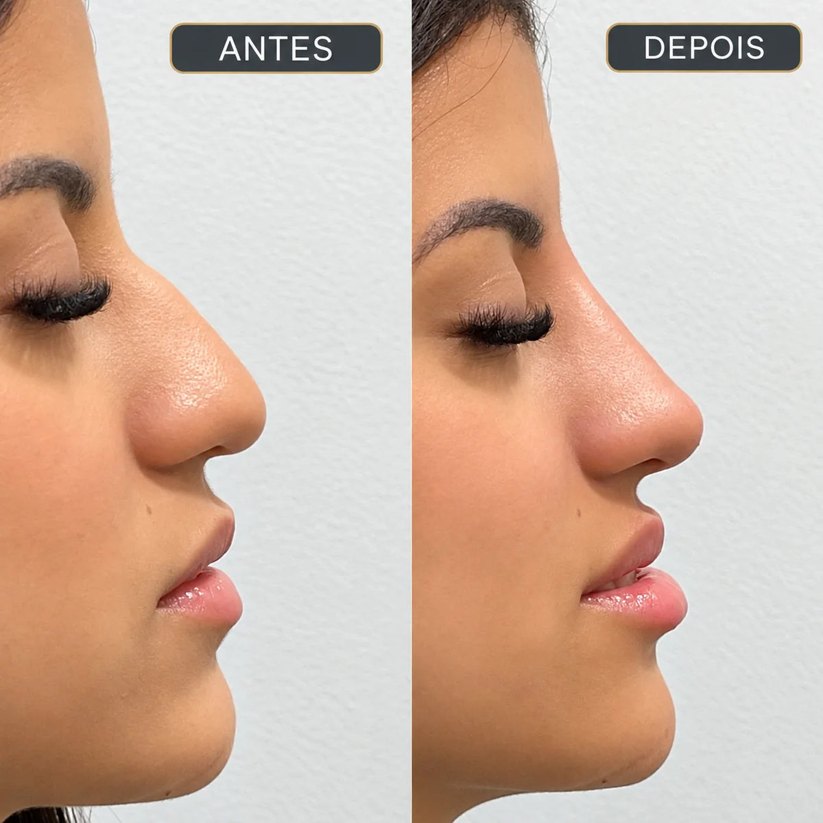 Rinomodelação com Restylane Lyft sem Cirurgia