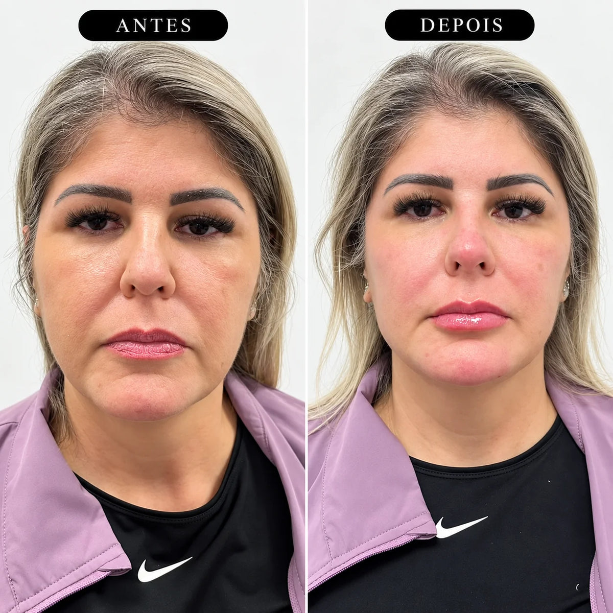 Preenchimento Malar Restylane Volyme com Anestesia