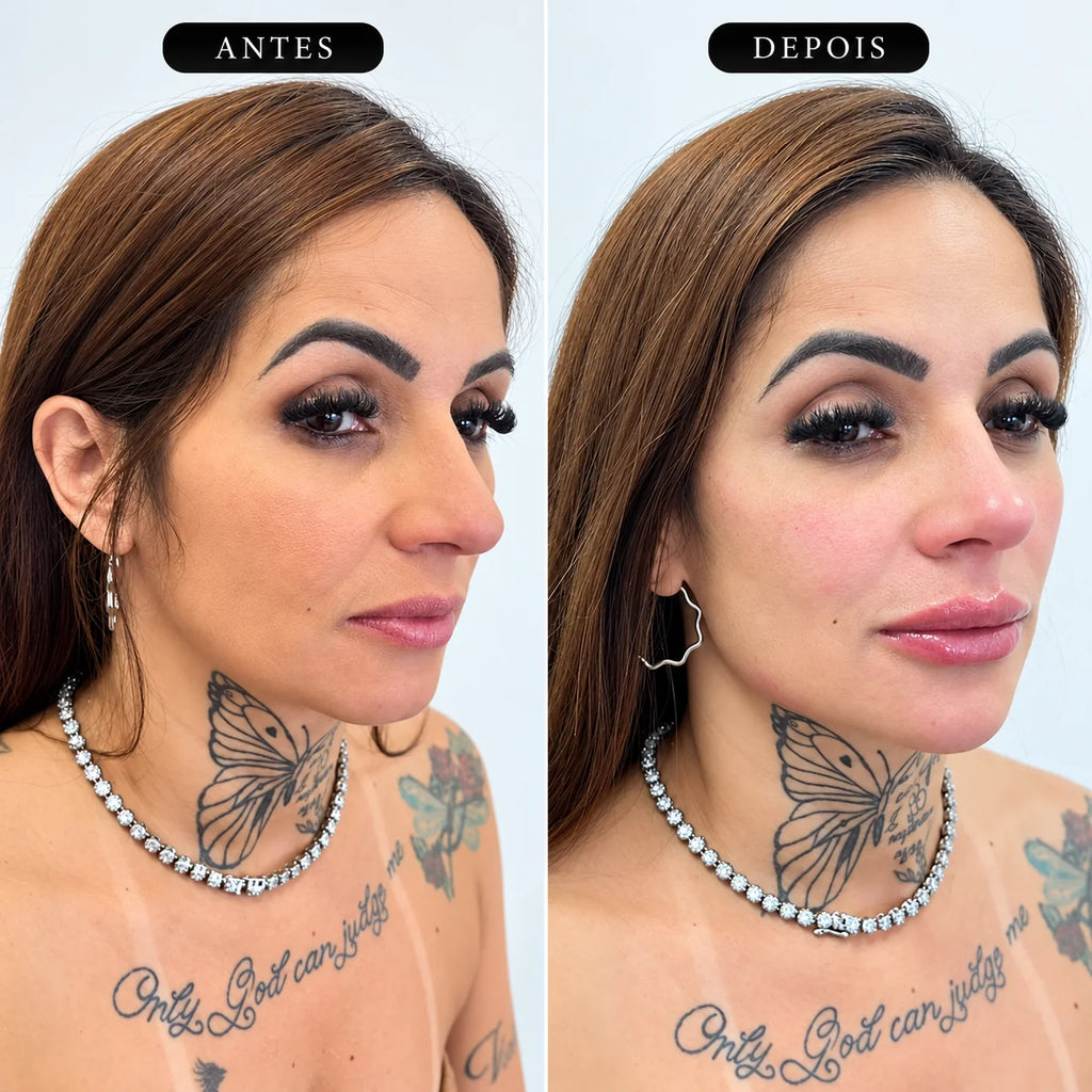 Preenchimento Malar Restylane Volyme com Anestesia