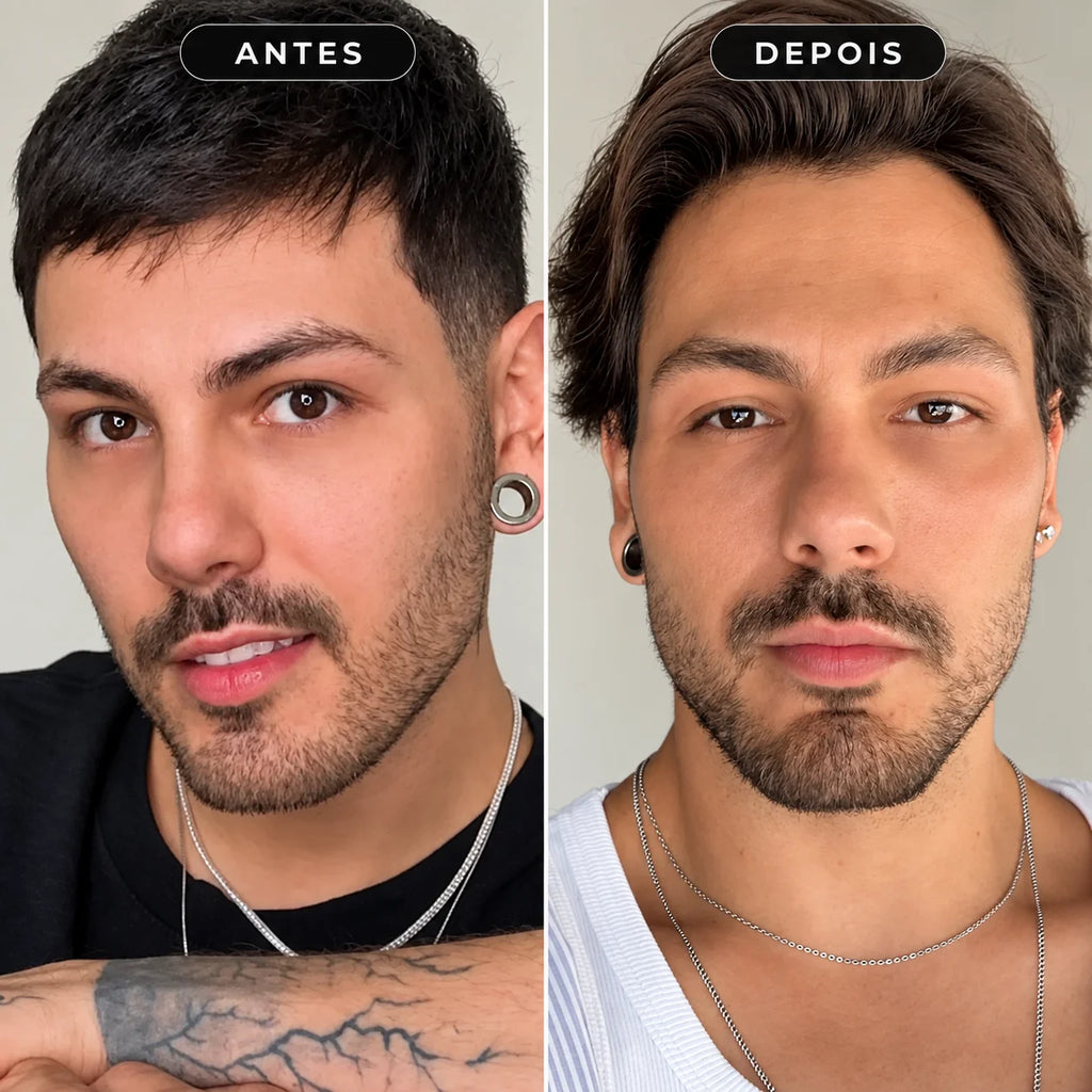 Preenchimento de Mandíbula Restylane Defyne com Anestesia