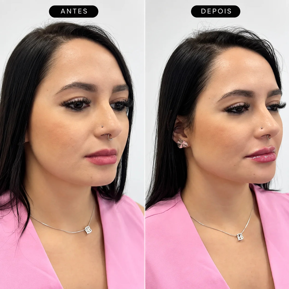 Preenchimento de Mandíbula Restylane Defyne com Anestesia