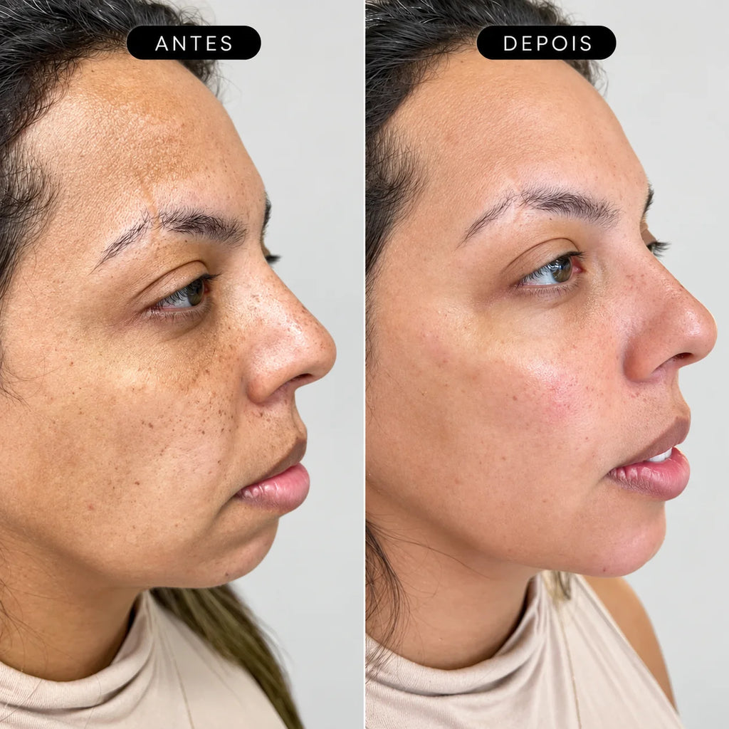 Preenchimento Pré-Jowls Restylane Defyne com Anestesia