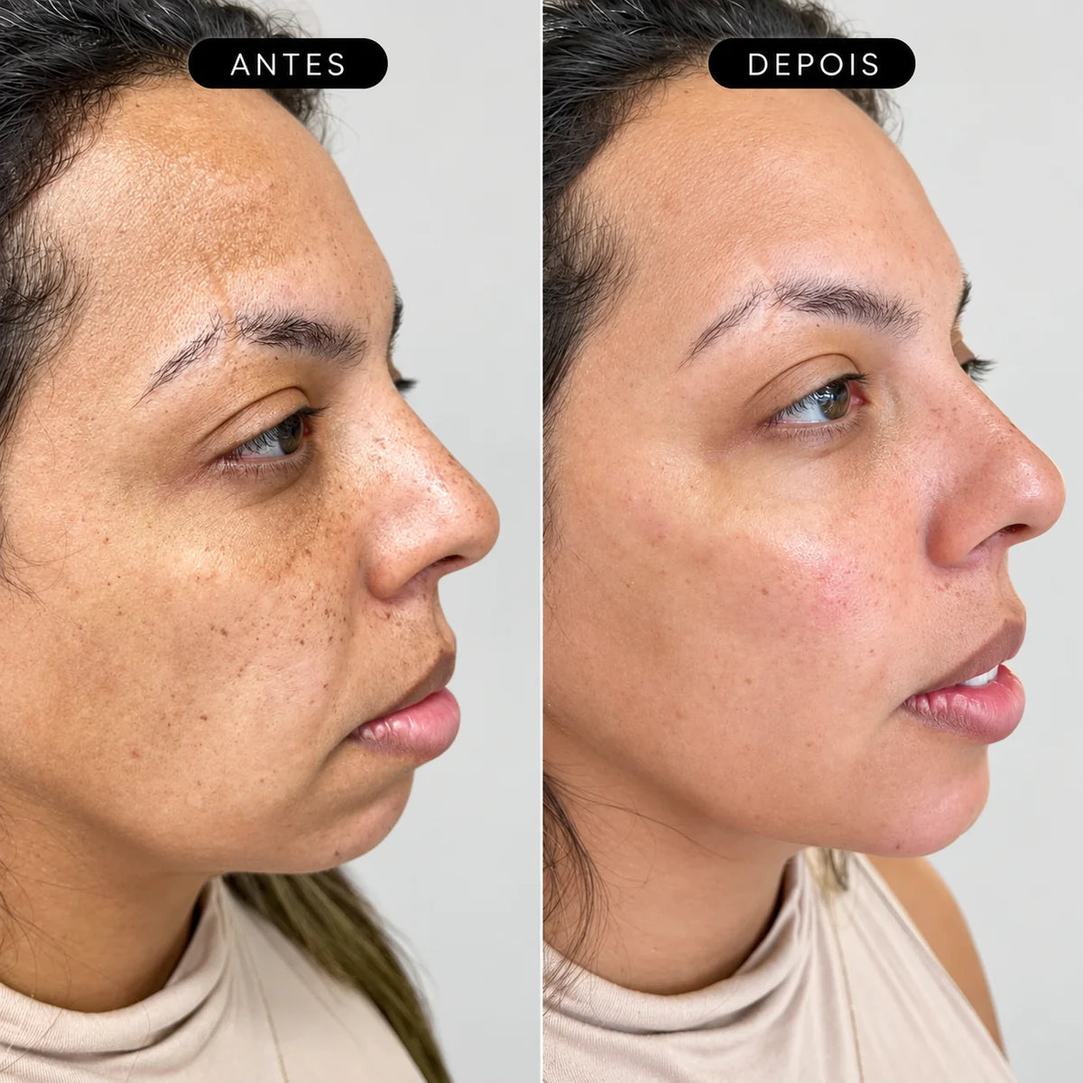 Preenchimento Pré-Jowls Restylane Defyne com Anestesia