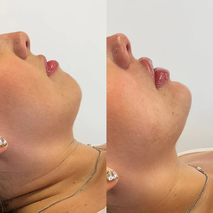 MAP 3 - Perfiloplastia