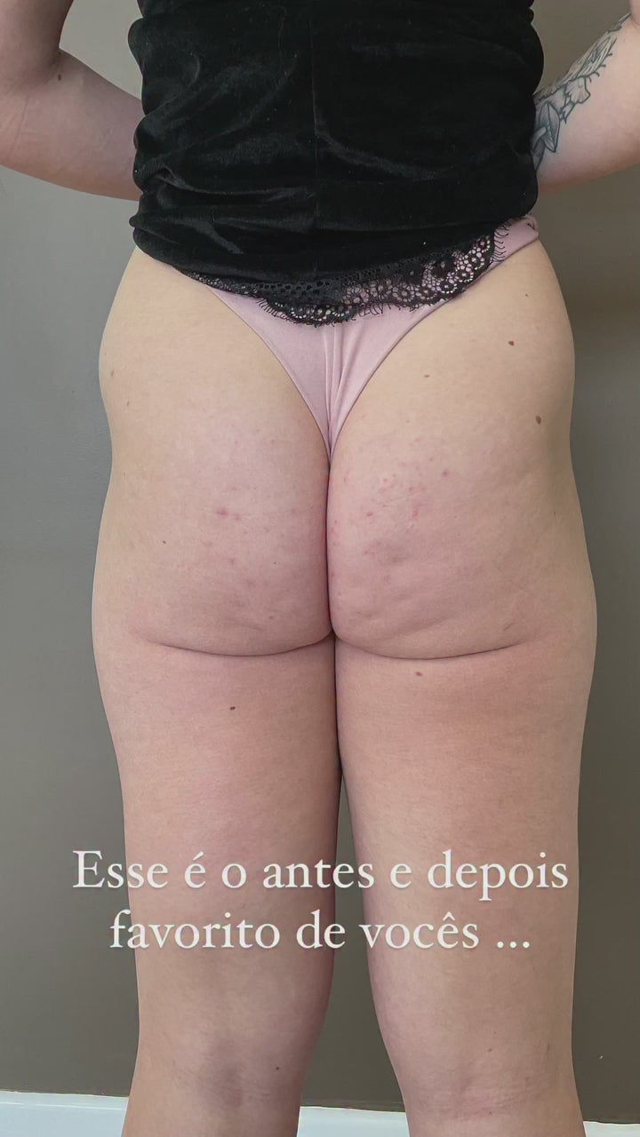 Remodelação Glútea